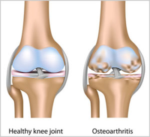 therapy for Osteoarthritis